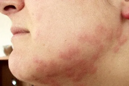 Cluster of bed bug bite welts on skin